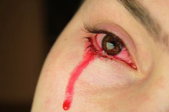Cómo la menstruación puede hacer que una mujer llore lágrimas de sangre